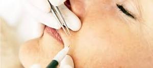 Elektrische epilatie. rotterdam