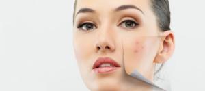 acne behandeling rotterdam